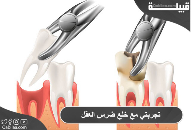 تجربتي مع خلع ضرس العقل