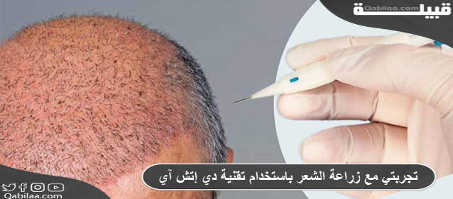 تجربتي مع زراعة الشعر باستخدام تقنية دي إتش آي