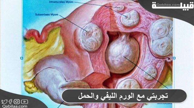 تجربتي مع الورم الليفي والحمل