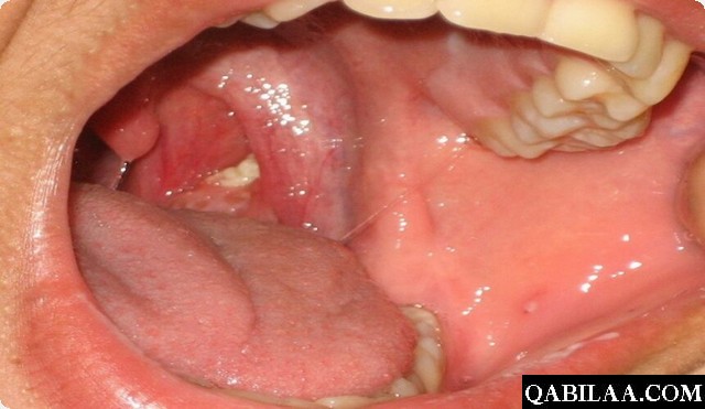 علاج حصى اللوزتين بالأعشاب