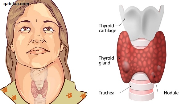 هل الغدة الدرقية تسبب ألم في الحنجرة؟ أم أن ألم الحلق له أسباب أخرى؟
